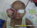 IDC Bantu Pengobatan Tumor Mata Ganas (Retinoblastoma)